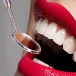 The 5 good reasons to have a dental veneer
