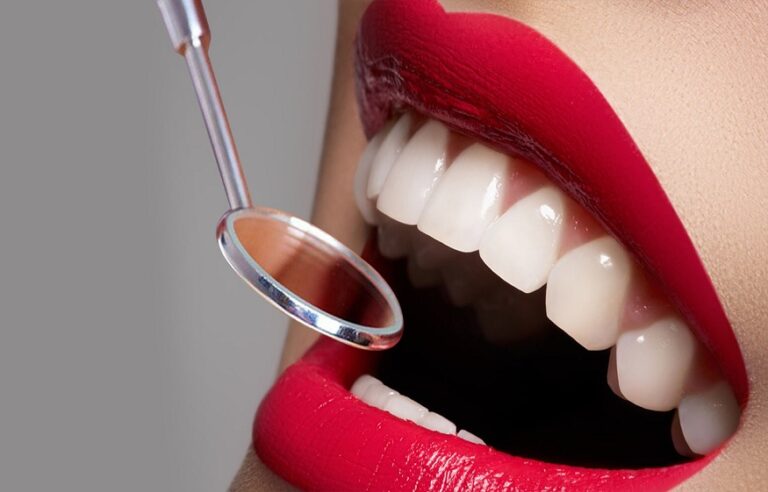 The 5 good reasons to have a dental veneer